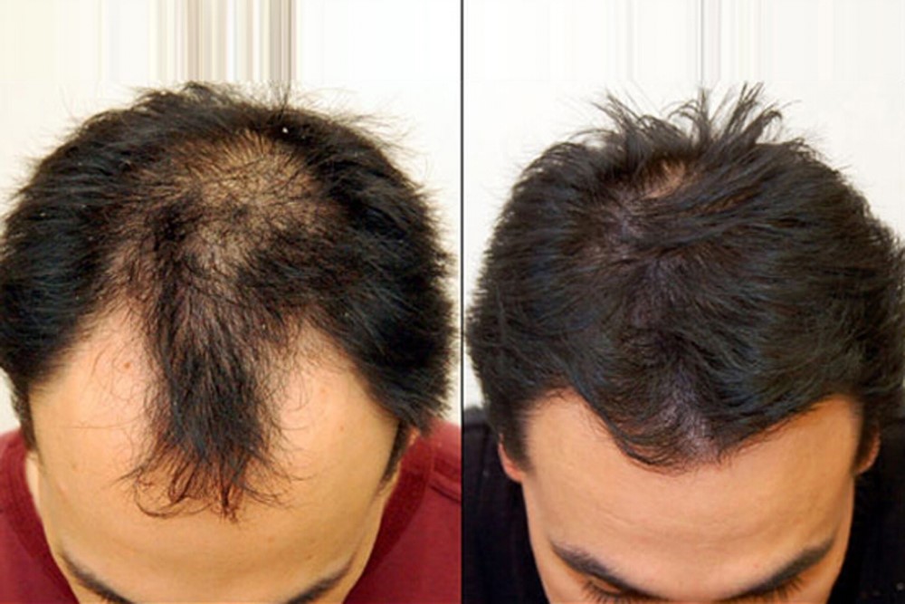 #Know The Process Of Smart Graft Hair Restoration