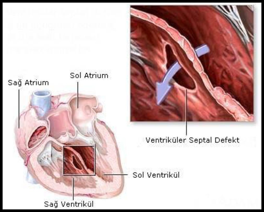 Открыт vsd. Ventricular Septal defect. Ventricular Septum. Postinfarction ventricular Septal defect. Ventricular Septal defect Sound.